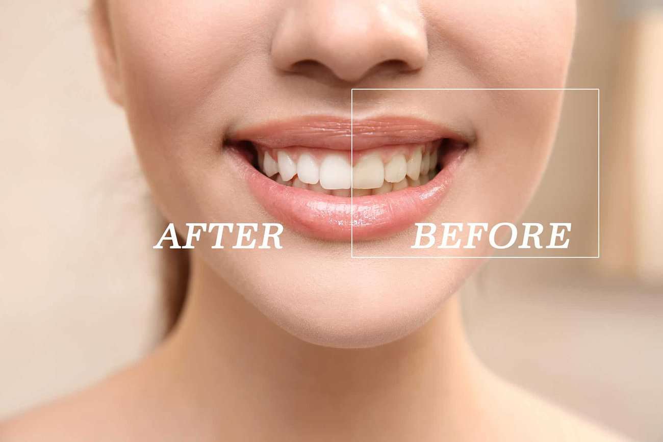 How Can You Maintain a Consistent Smile Shade with Crowns Solihull?