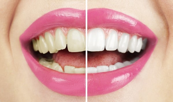 What Makes Ultima White Teeth Whitening Different Solihull
