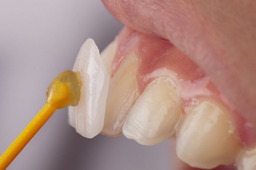 Why Do Dental Crowns Fail or Get Damaged Prematurely Solihull?