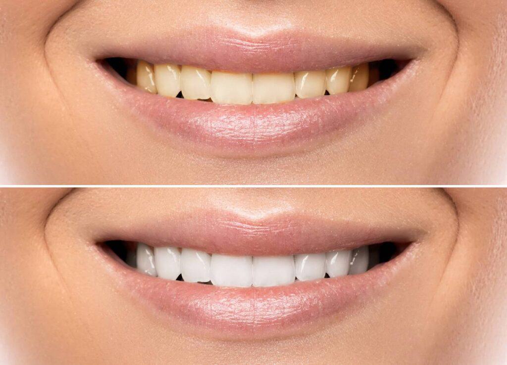 How Does Gum Disease Progress if Left Untreated Solihull?