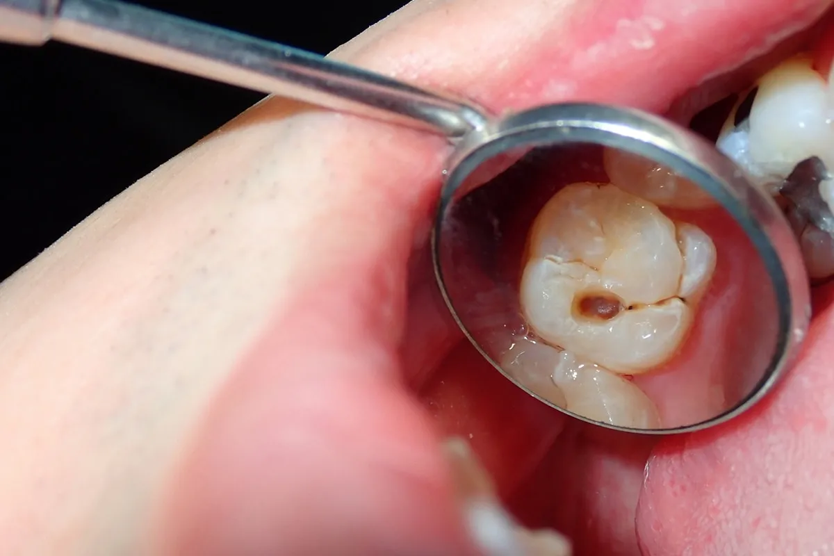 Why Do Teeth Crack? Common Causes to Know Solihull