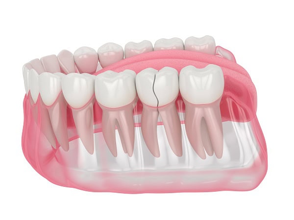 How Can You Manage Pain and Discomfort After a Root Canal Solihull?