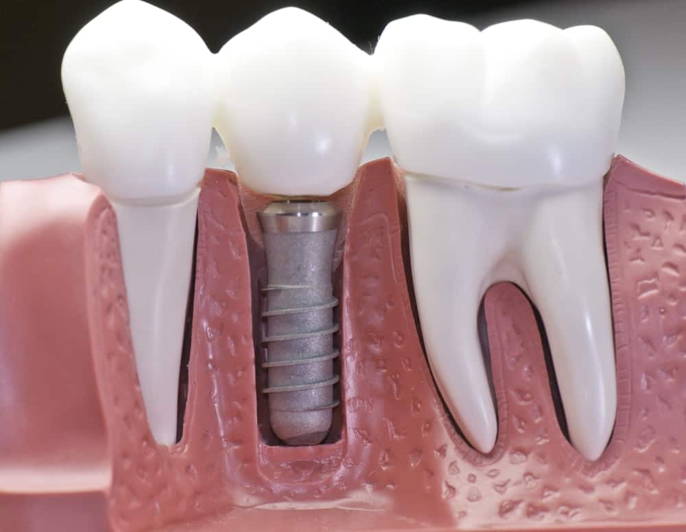 Who Is a Good Candidate for Dental Implants Solihull?