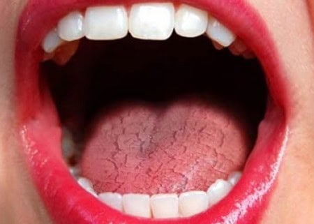 Dry Mouth and Its Role in Tooth Decay Solihull