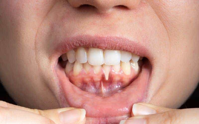 How Can Gum Disease Be Prevented Solihull?