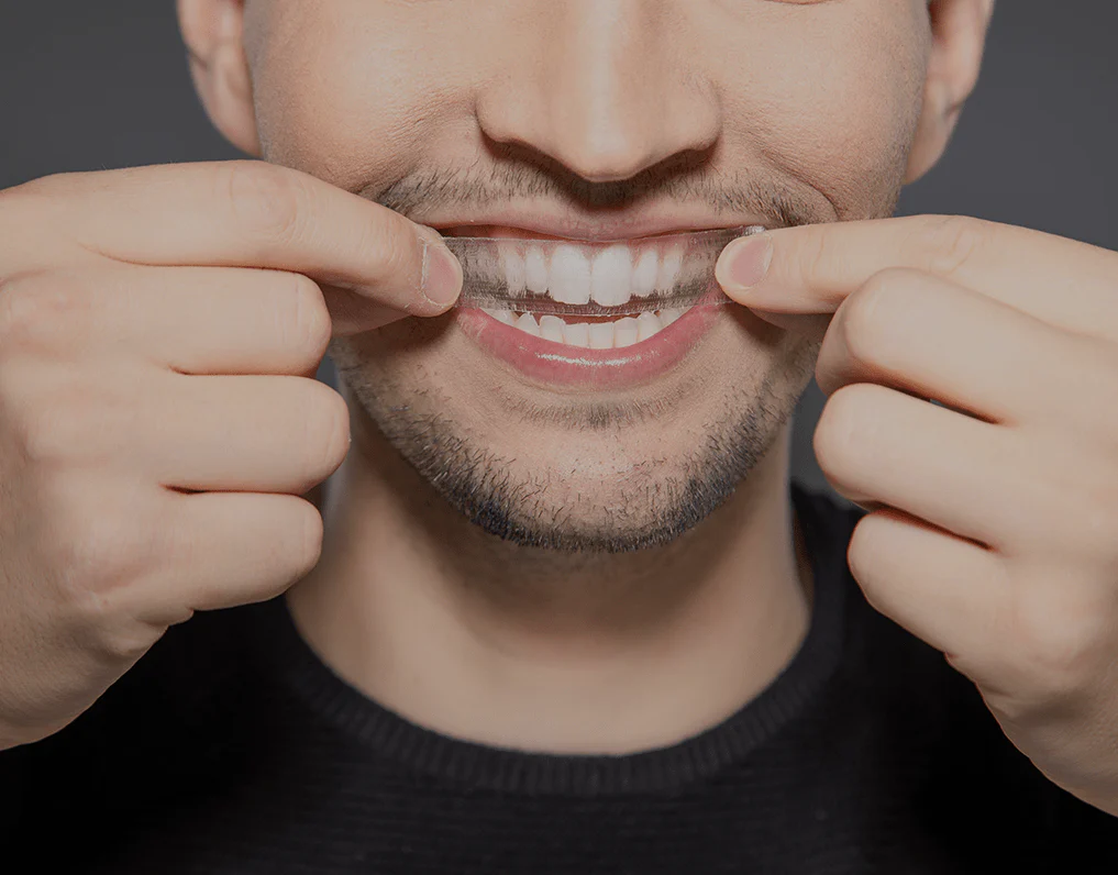 Can You Whiten Natural Teeth Without Harsh Chemicals Solihull?