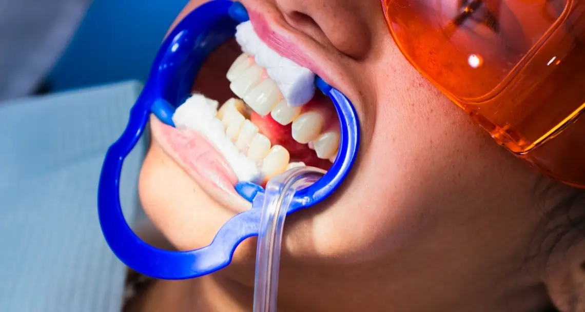 How Teeth Whitening Treatments Actually Work on Your Enamel Solihull