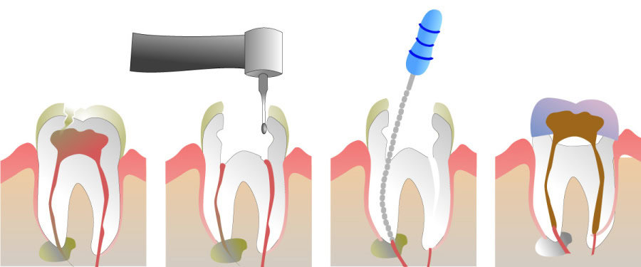 How Do You Properly Care for Your Teeth After a Root Canal Solihull