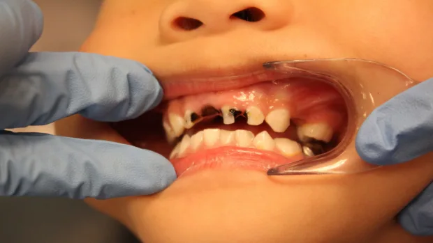 Which Foods and Drinks Cause the Most Damage to Young Smiles Solihull?