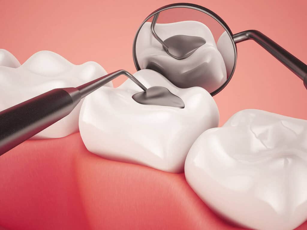 How Can You Prevent Tooth Decay Effectively Solihull