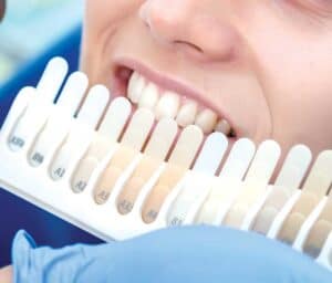 Ultimate Guide to Teeth Whitening with Natural Ingredients Solihull