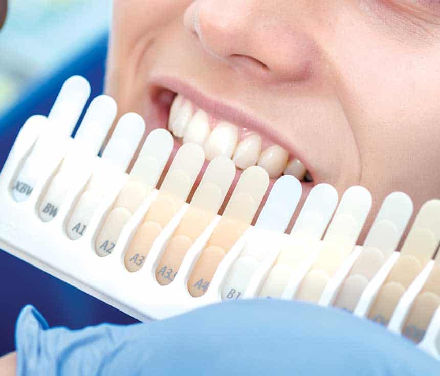 Professional vs At-Home Whitening: What You Need to Know Solihull