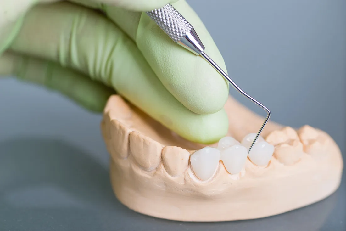 Do Braces Take Years to Show Results Solihull