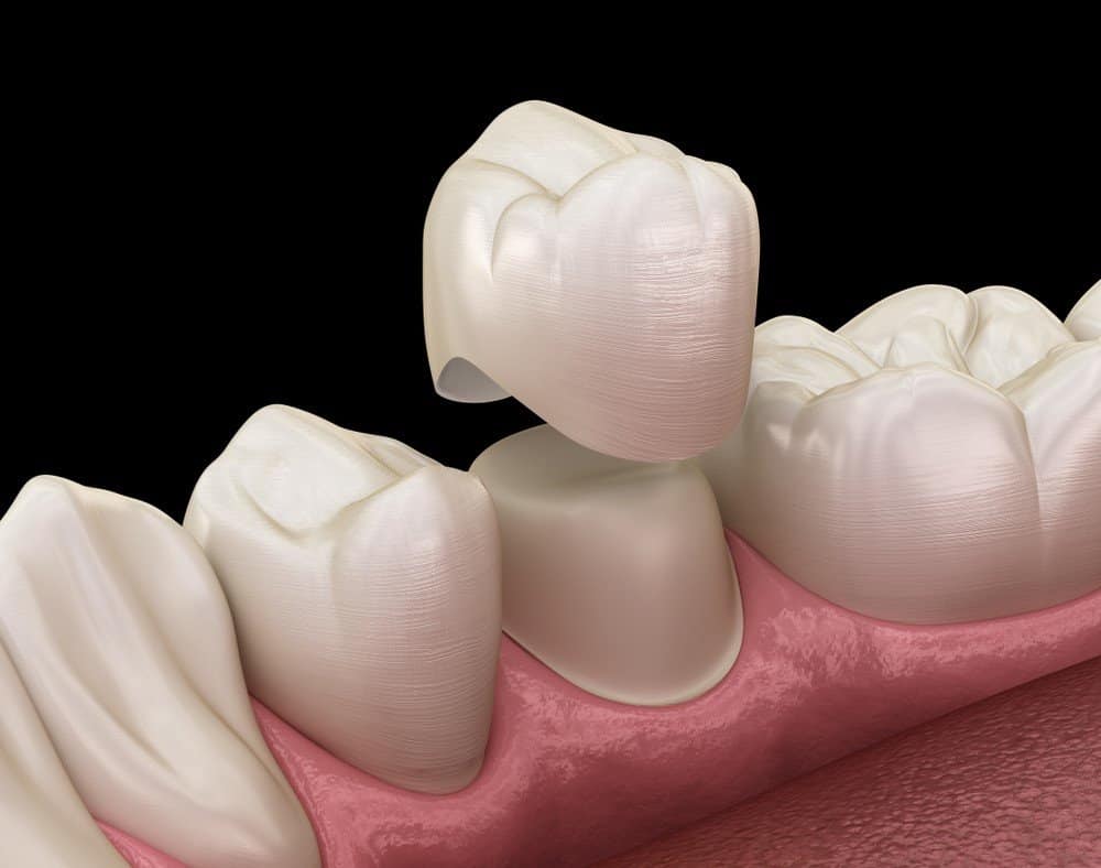 What is the Procedure for Getting Dental Implants Solihull?