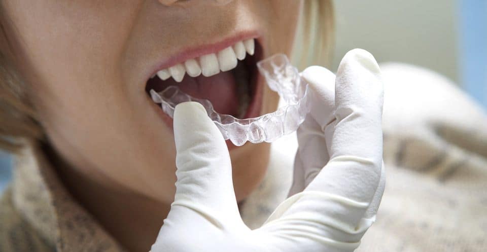 Why Bleaching Trays Require More Time Solihull